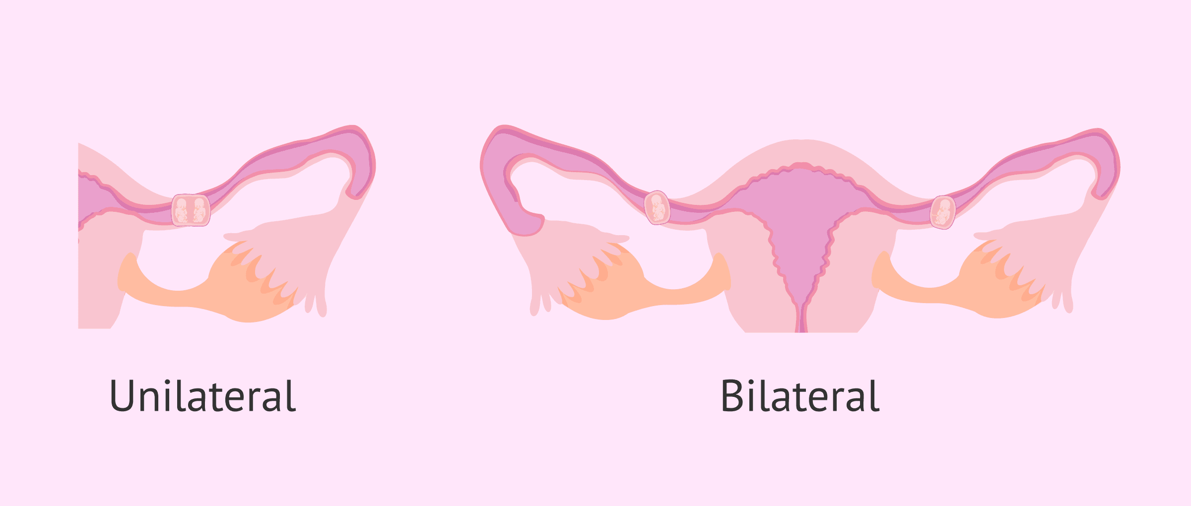 ¿Es posible el embarazo ectópico gemelar o múltiple?