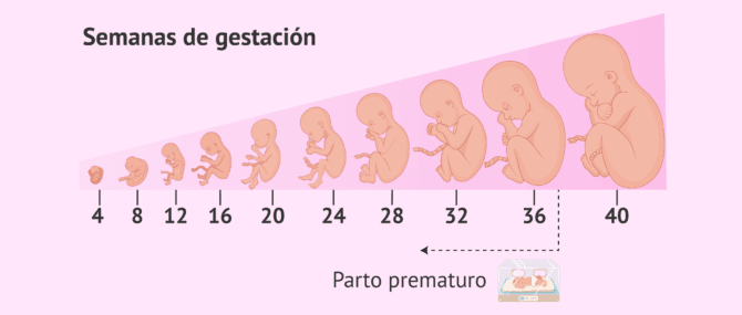 Imagen: Parto prematuro como posible complicación del embarazo