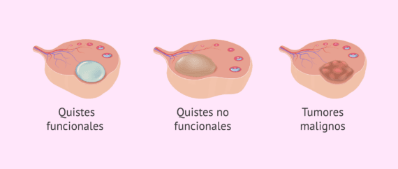 Los Quistes Se Mueven Como Un Bebe