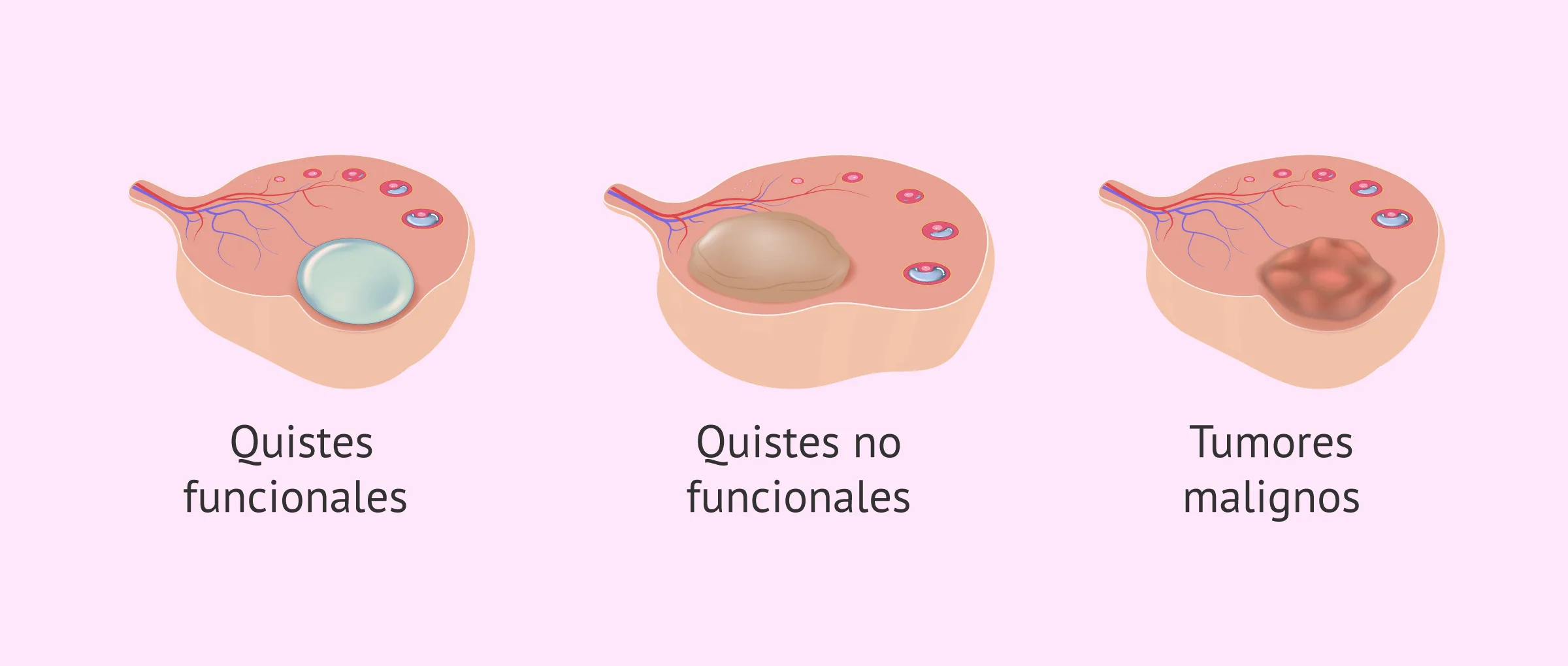 quiste-de-ovarios-binipatia-e-higienismo-eliminaci-n-de-quistes