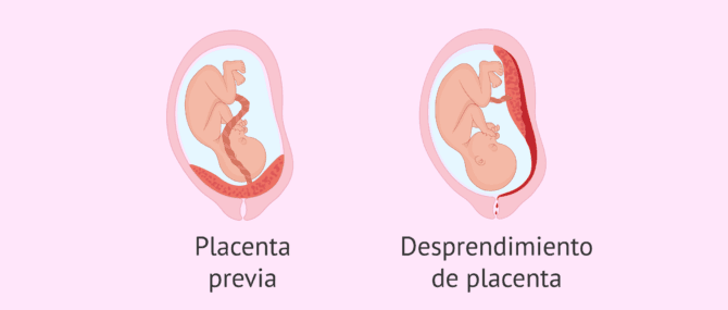 Imagen: Complicaciones en el embarazo por problemas en la placenta