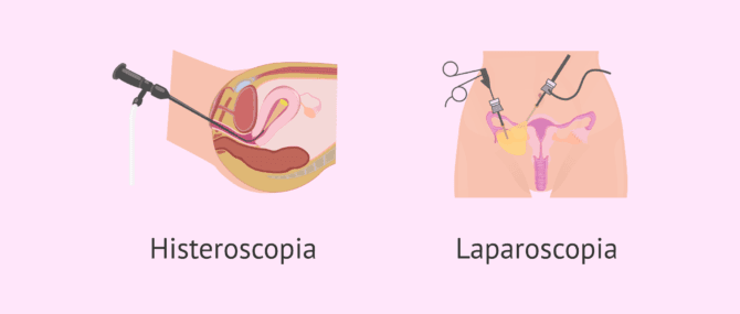 Imagen: Comparación de la histeroscopia y la laparoscopia
