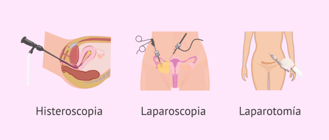 Imagen: ¿Cómo se puede realizar una miomectomía?