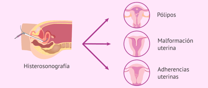 Imagen: Usos de la histerosonografía