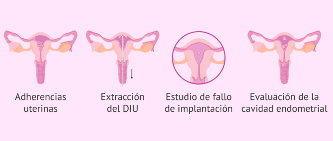 Imagen: ¿Cuándo está indicada la histeroscopia diagnóstica?