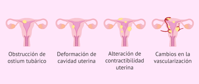 Imagen: ¿Cómo pueden afectar los miomas uterinos a la fertilidad?