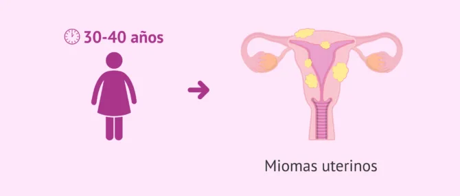 Imagen: ¿Qué es un mioma y cuándo se diagnostica?