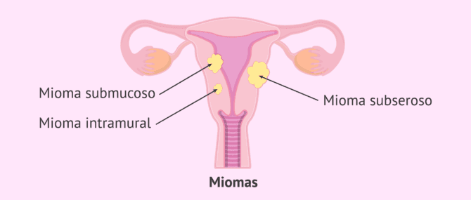 Imagen: Miomas en el útero