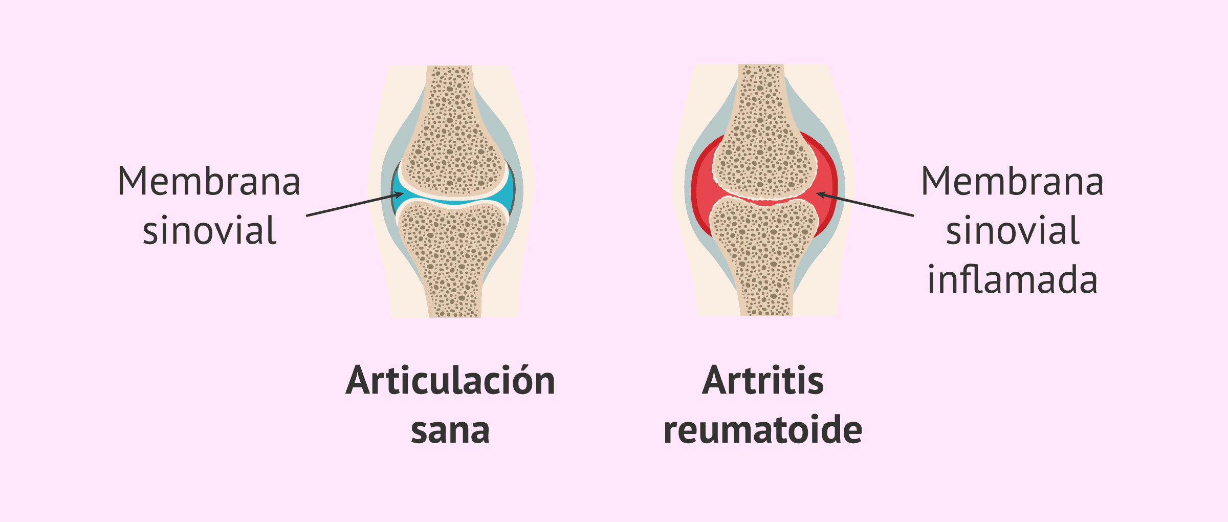 ¿Puedo quedar embarazada si tengo artritis reumatoide?