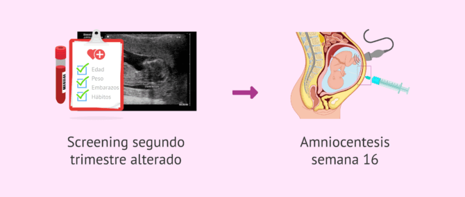 Imagen: Complementar el screening del segundo trimestre con la amniocentesis