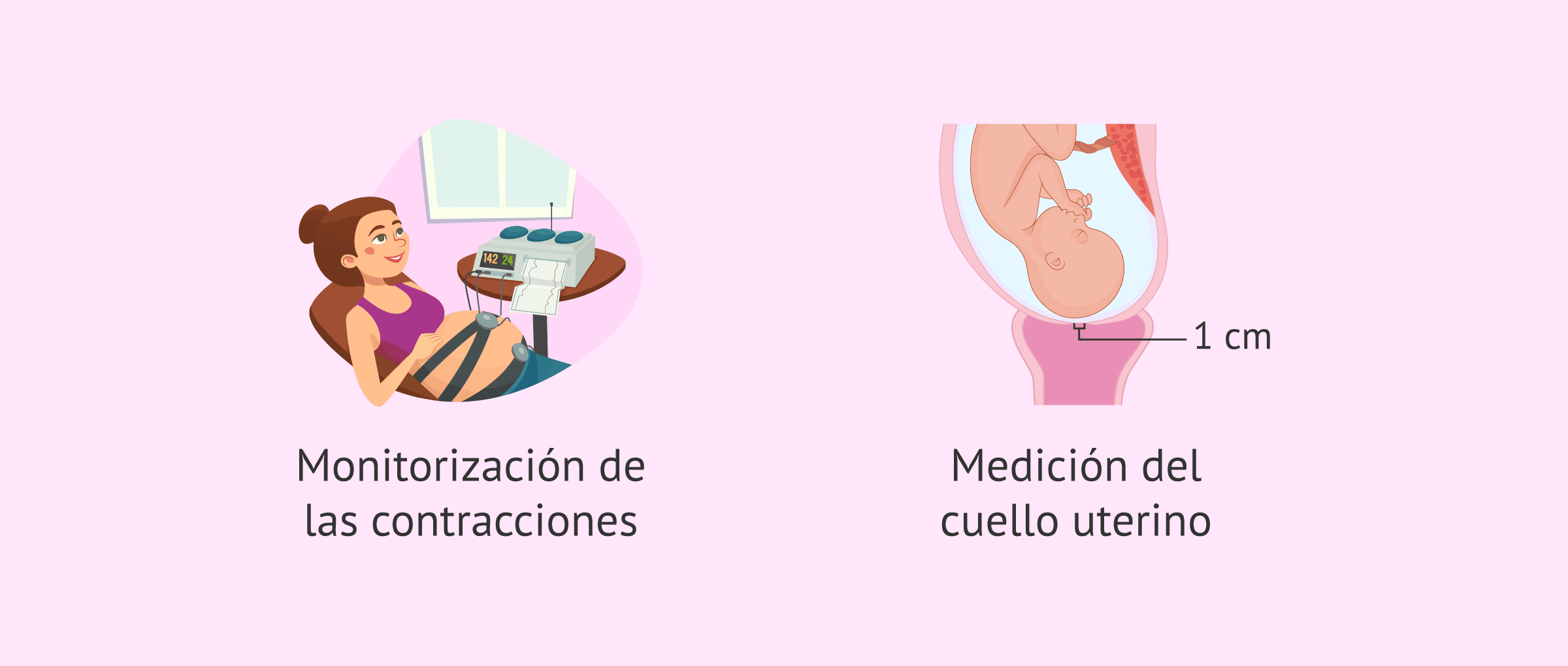 Imagen: Diagnóstico del parto prematuro