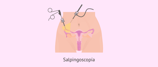 Imagen: salpingoscopia-glosario