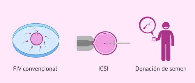 Imagen: Soluciones frente a la astenozoospermia para lograr el embarazo