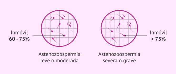Imagen: Tipos de astenozoospermia