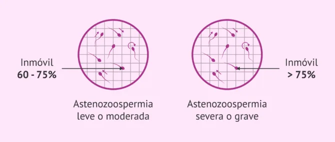 Imagen: Tipos de astenozoospermia