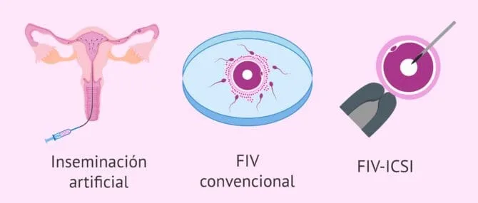 Imagen: Conseguir embarazo con oligozoospermia