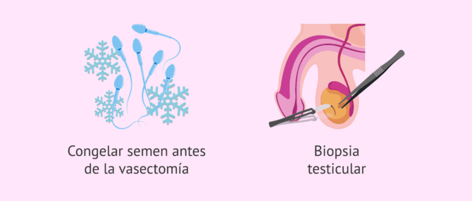 Imagen: Alternativas para ser padre con una vasectomía