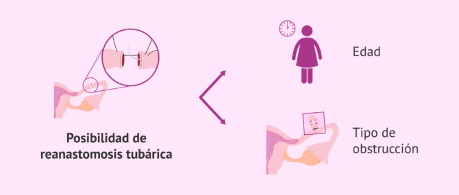 Imagen: Volver a ser madre después de la ligadura de trompas, ¿es posible?