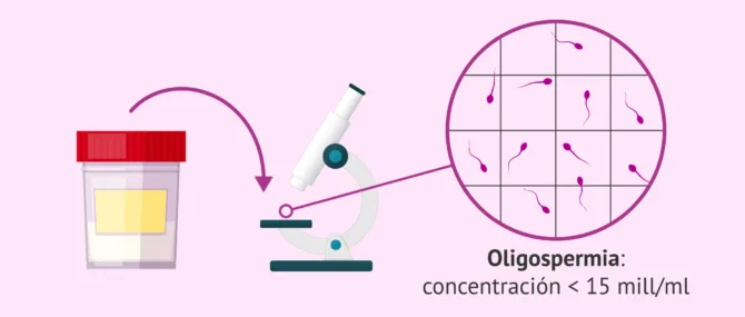 Imagen: Resultado de oligozoospermia en el seminograma