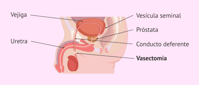 Imagen: La vasectomía consiste en bloquear los conductos deferentes