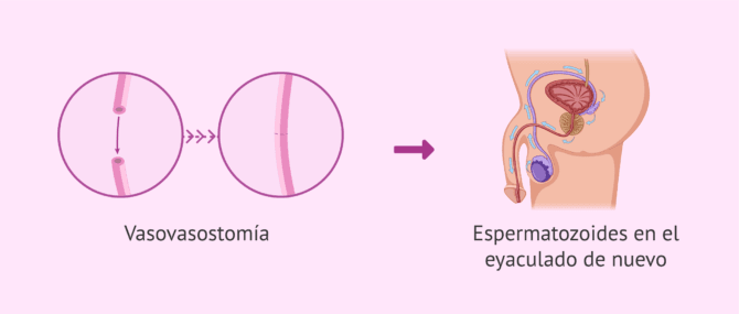 Imagen: Vasovasostomía para revertir la vasectomía