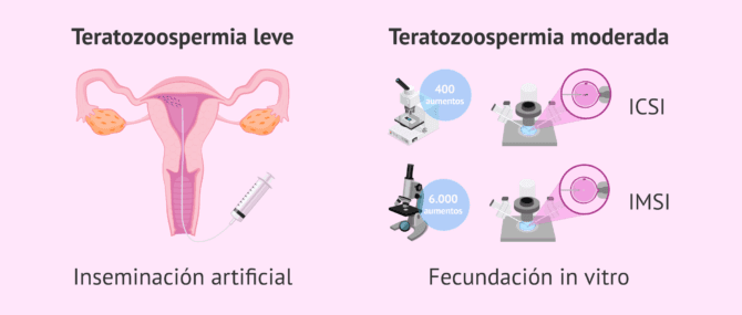 Imagen: Embarazo con teratozoospermia