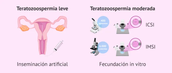 Imagen: Embarazo con teratozoospermia