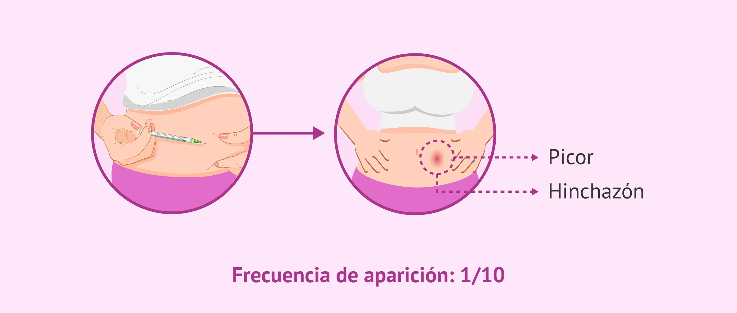 Efectos secundarios frecuentes del Orgalutran