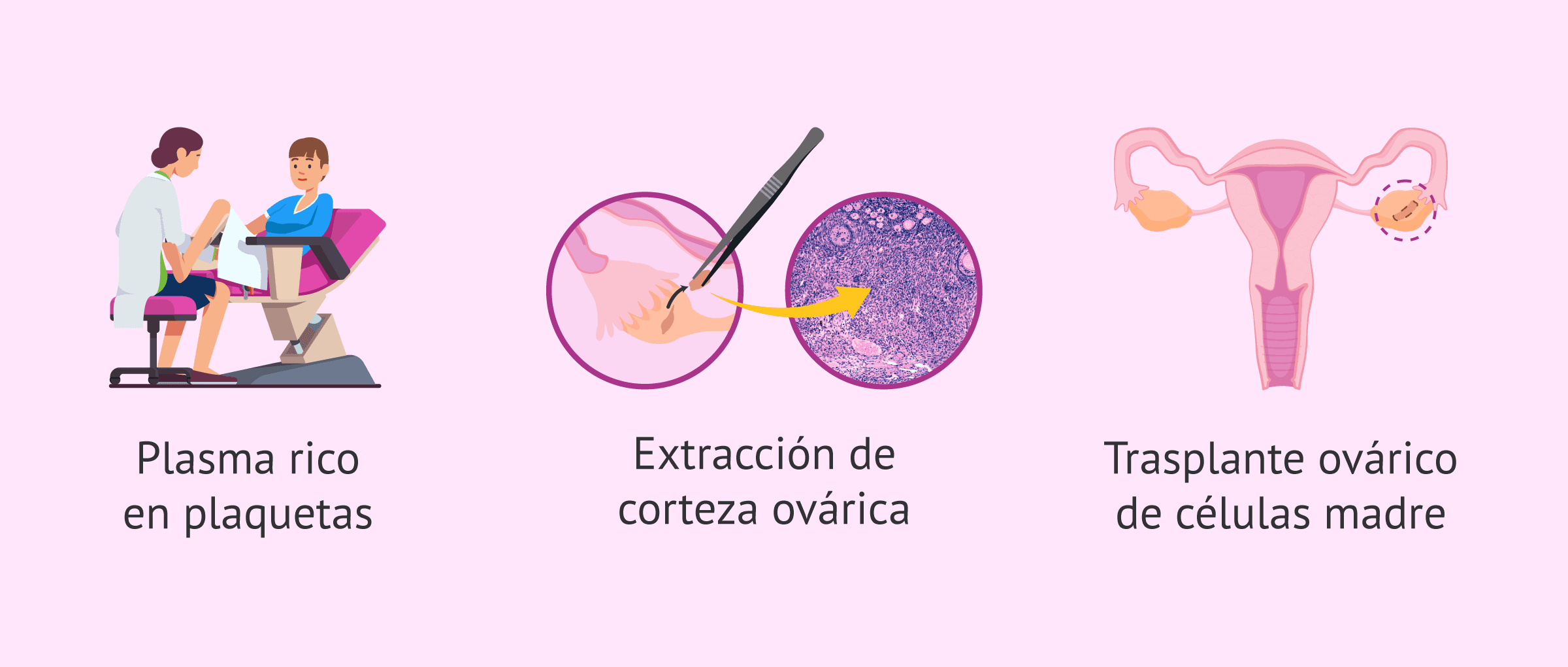 Imagen: rejuvenecimiento-ovarico-glosario