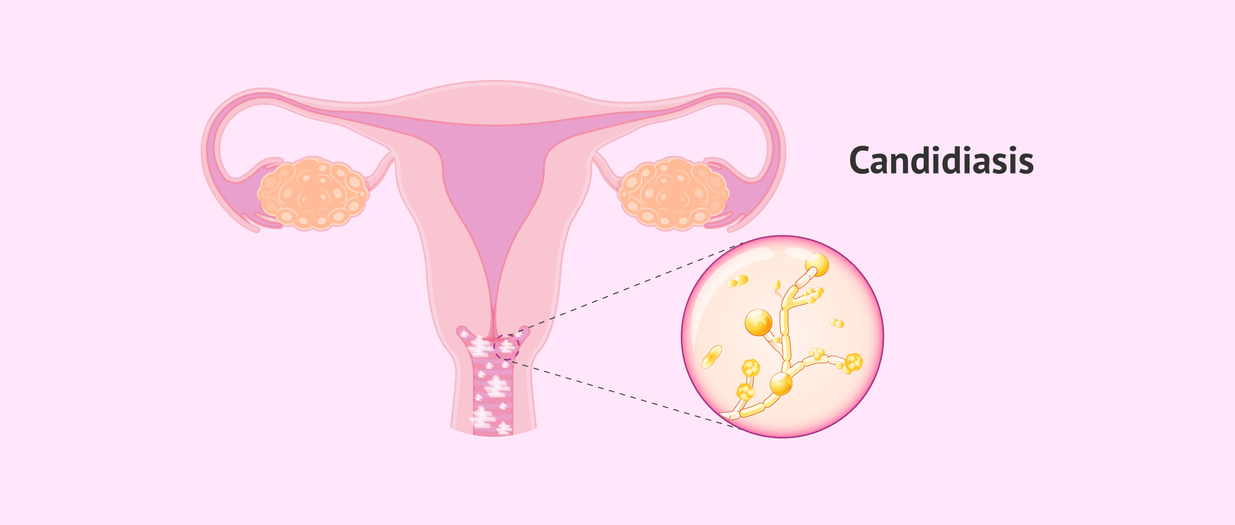 Imagen: candidiasis-glosario