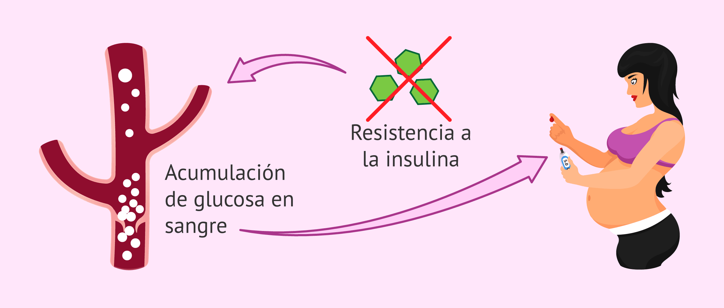 Imagen: Desarrollo de la diabetes gestacional