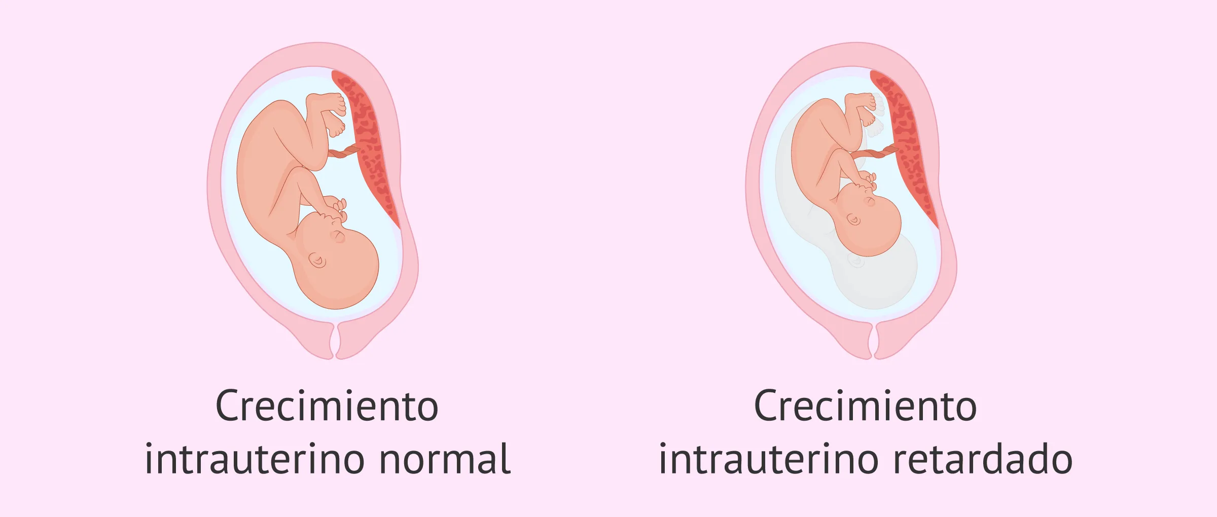 Imagen: ¿En qué consiste el crecimiento intrauterino retardado?
