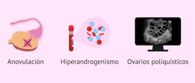 Imagen: Criterios de Rotterdam: anovulación, hiperandrogenismo y ovarios poliquísticos