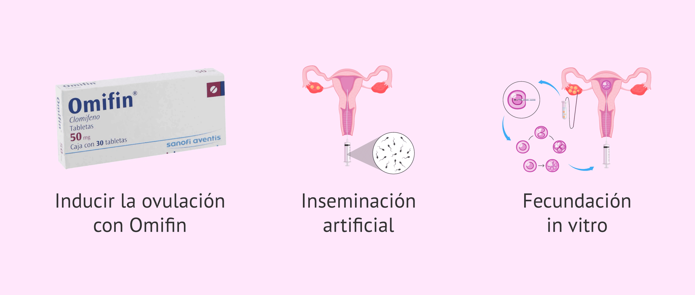 Imagen: Opciones de lograr un embarazo con SOP