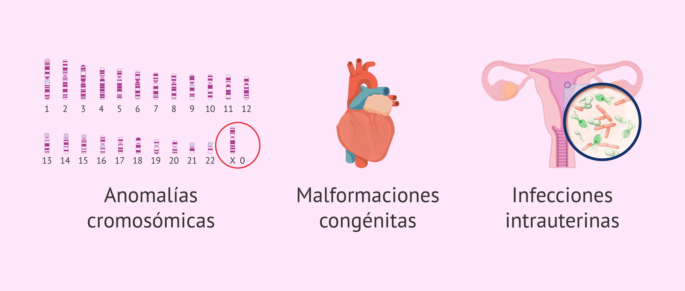 Imagen: Retardo del crecimiento intrauterino