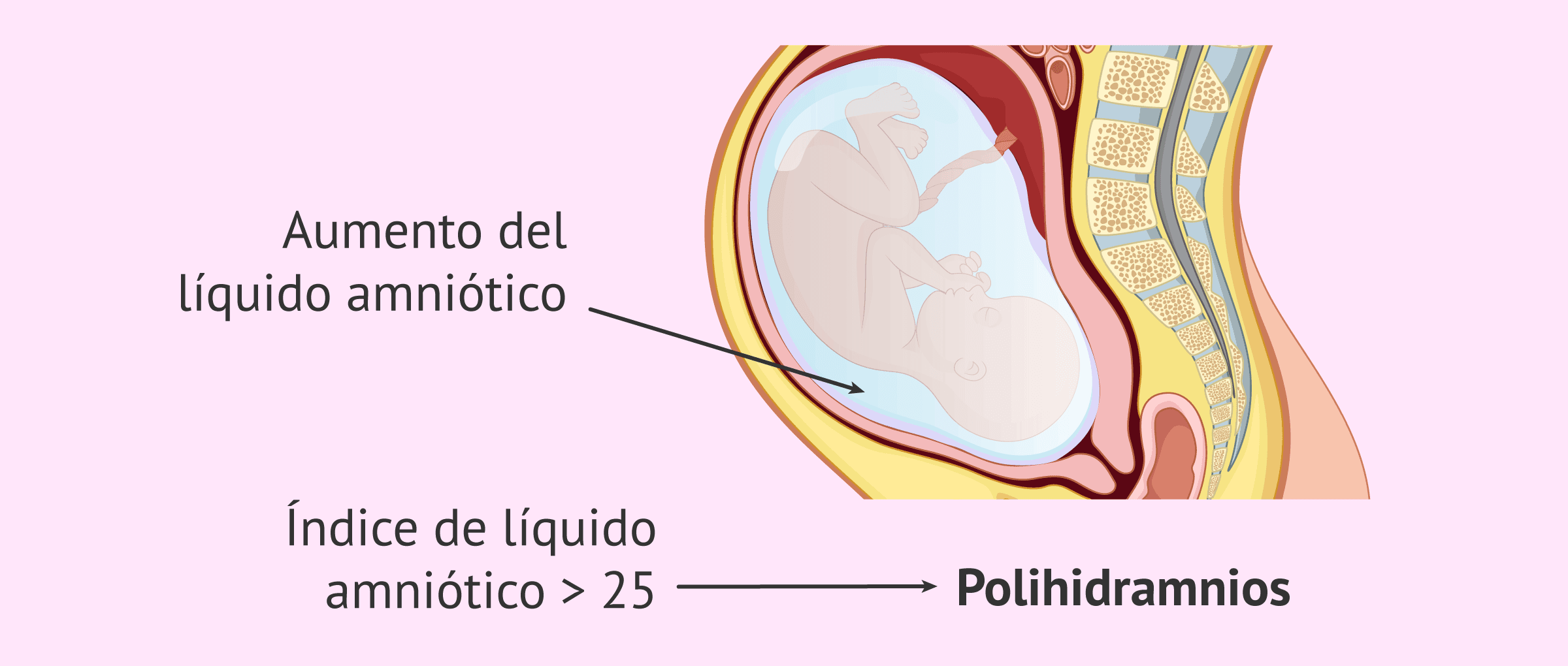 Imagen: ¿En qué consiste el polihidramnios o aumento de líquido amniótico?