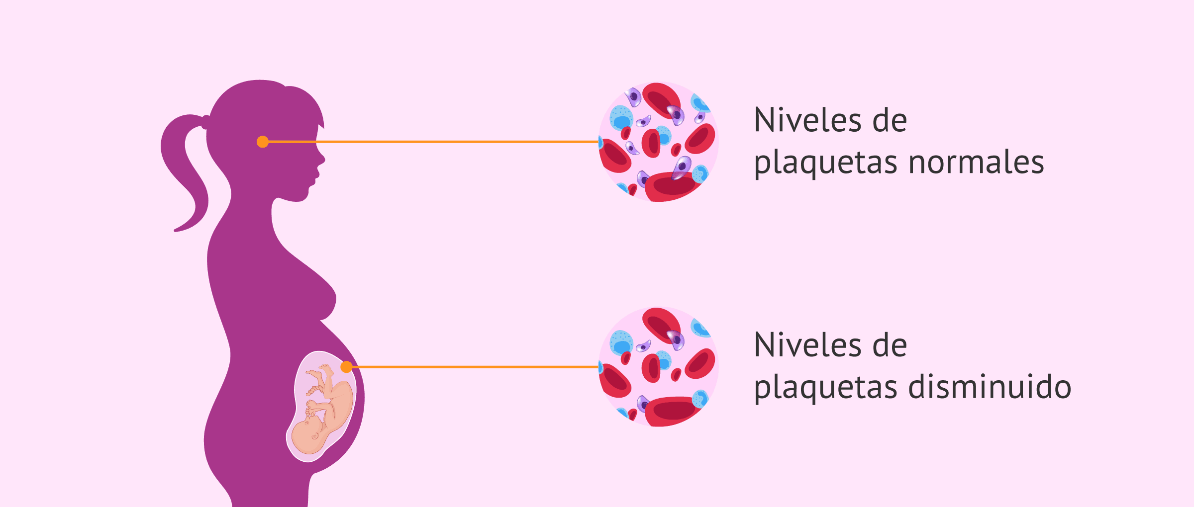 Imagen: ¿Qué es la trombocitopenia aloinmune o neonatal?