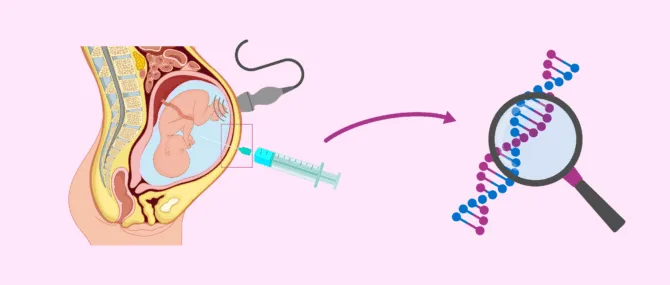 Imagen: Amniocentesis