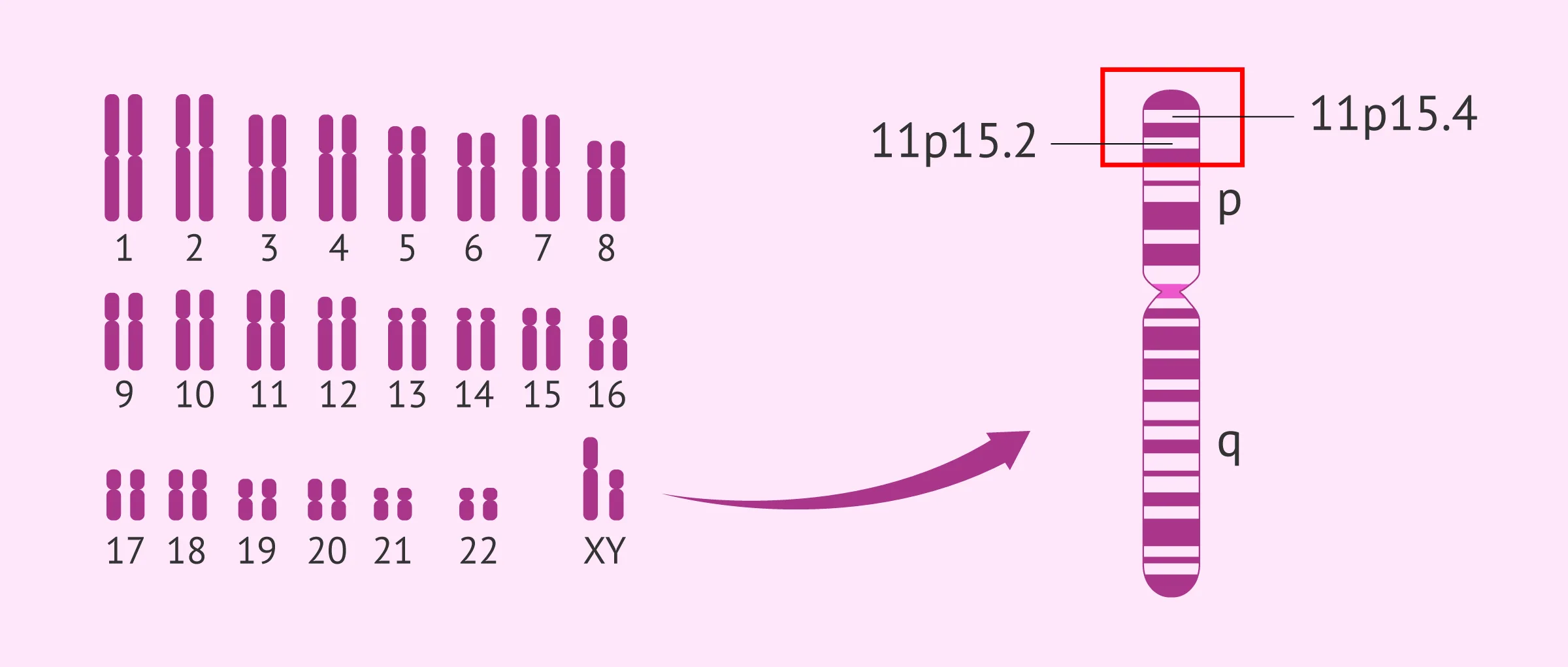 Imagen: Cromosoma afectado en Síndrome de Beckwith Wiedemannel
