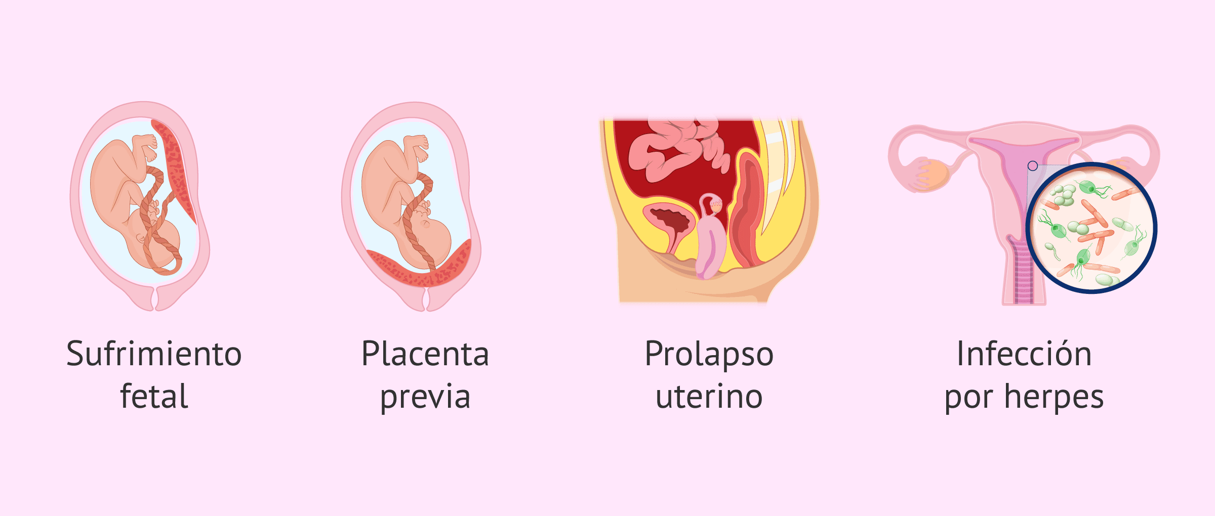 Imagen: Situaciones en las que no está indicada el uso de oxitocina sintética