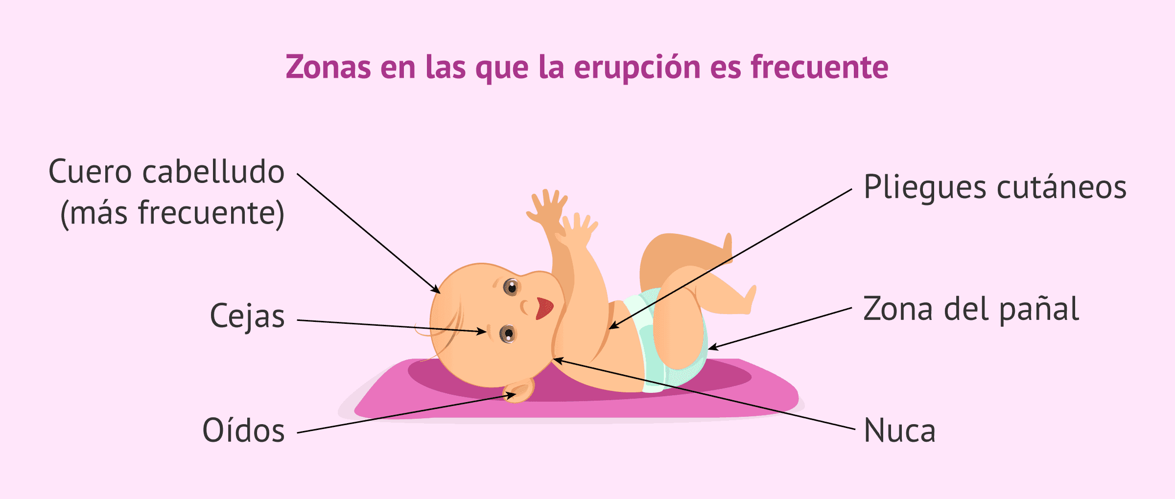 ¿En qué consiste la costra láctea y cuáles son sus síntomas y soluciones?