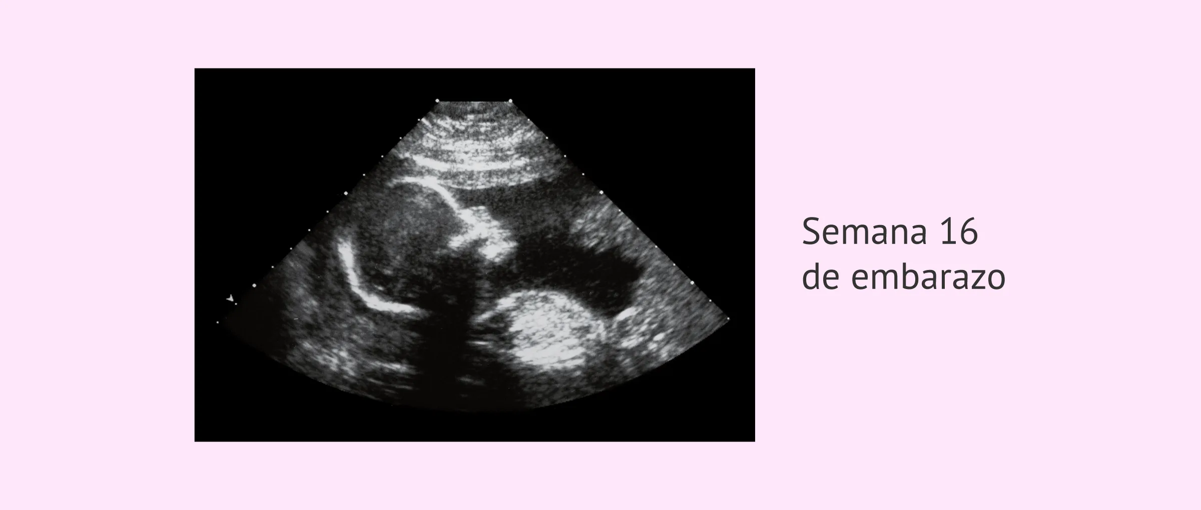 Imagen: Ecografía de la semana 16 de embarazo