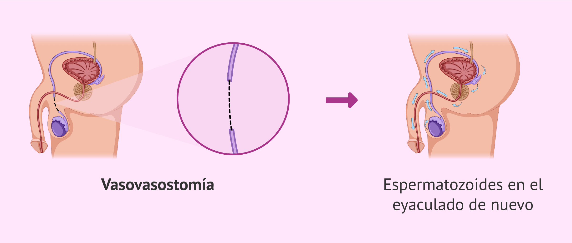 Imagen: Recanalización del semen
