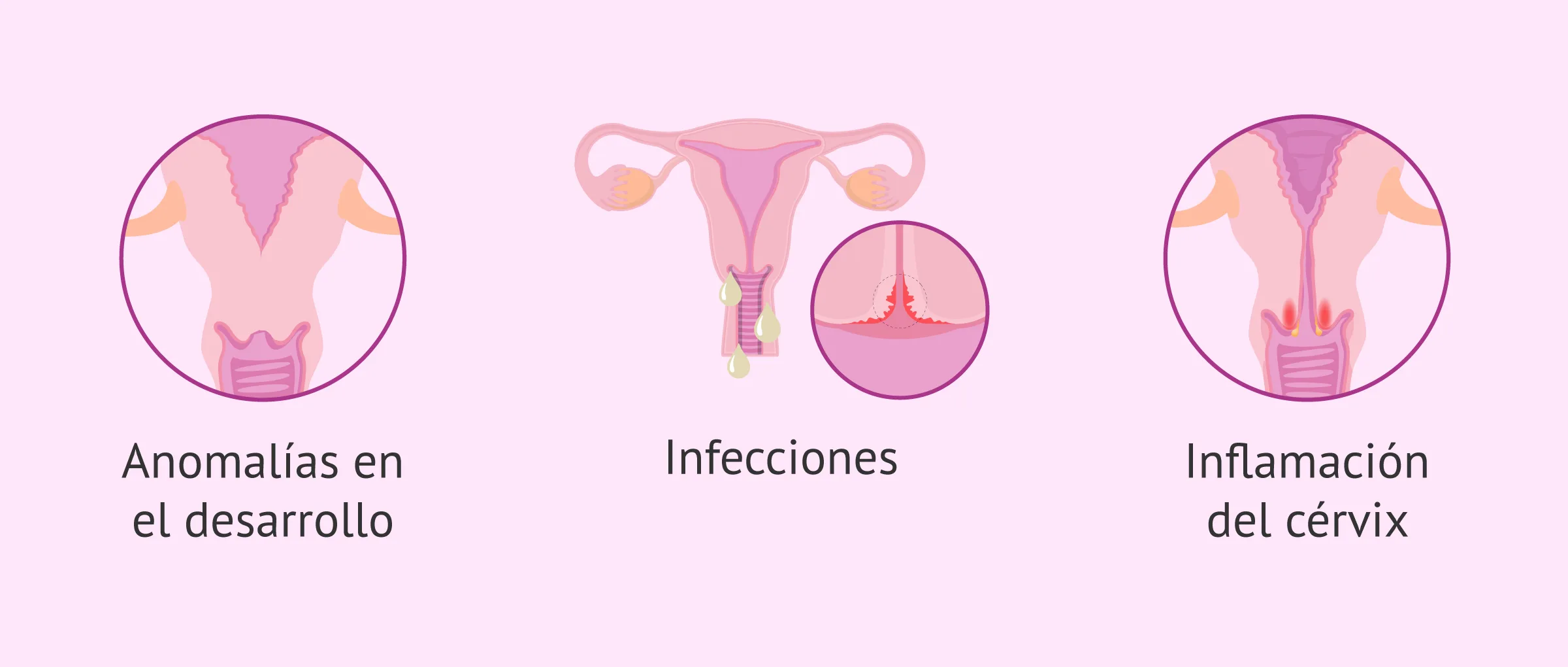 Imagen: Infertilidad femenina por factor cervical