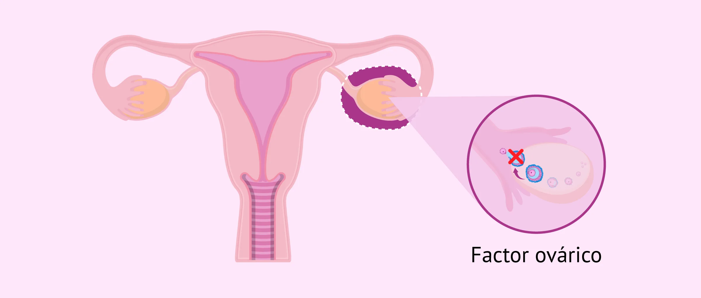 Imagen: Infertilidad femenina por factor ovárico