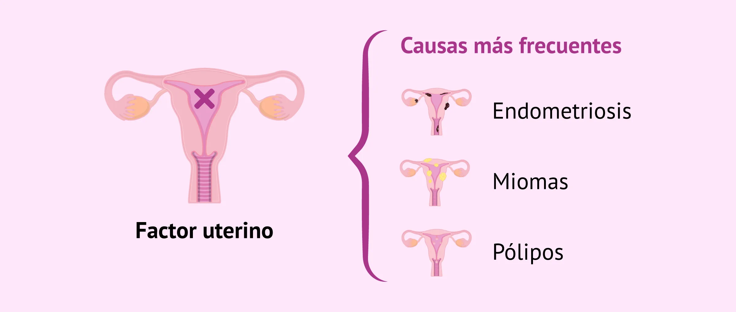 Imagen: Principales causas de la infertilidad femenina por factor uterino