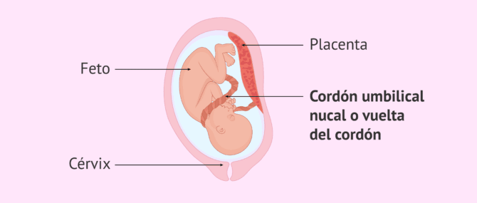 Imagen: ¿Qué es el cordón umbilical nucal?