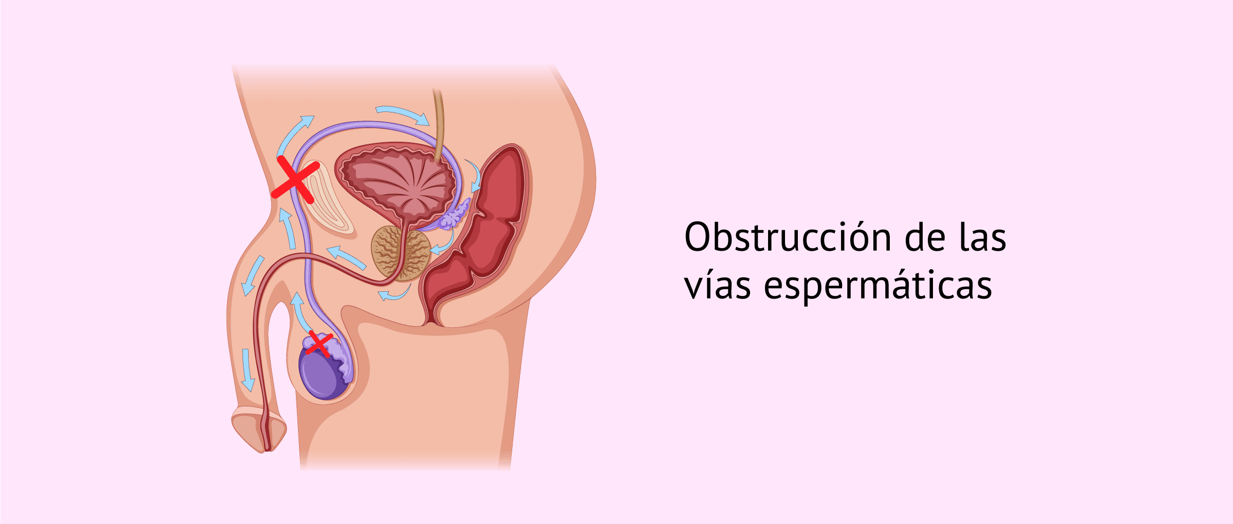 Imagen: Obstrucción del epidídimo, los conductos deferentes y la uretra