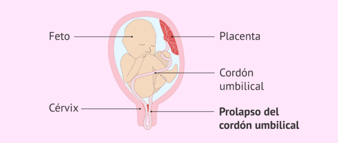 Imagen: Cordón umbilical prolapsado