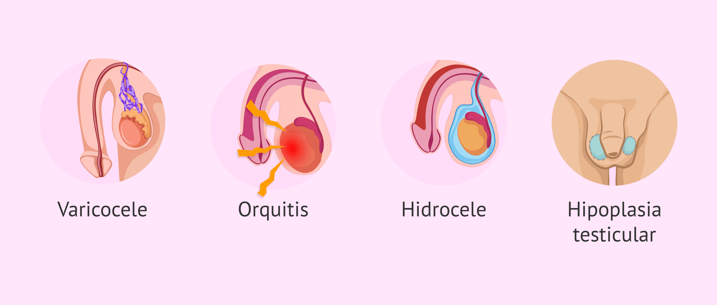 Imagen: Trastornos de origen testicular en el hombre